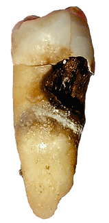 Toothdecay.png