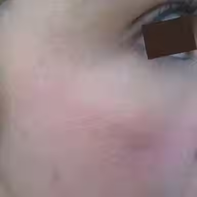 MELASMA REDUCTION AFTER 3 TIXEL TREATMENTS