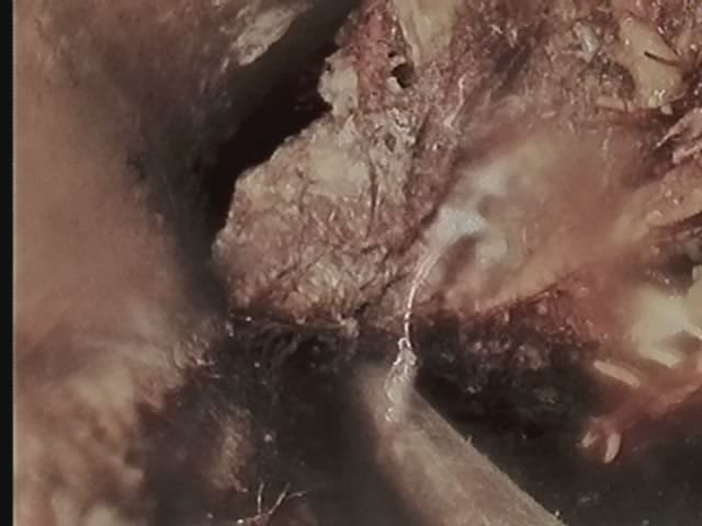 Image depicting insured sewage backup recovery services for a backyard sewage overflow. Affordable solutions for residential sewage cleanup and restoration.