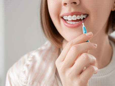 Putzen mit Brackets: So bleibt das Lächeln gesund