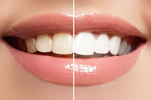Teeth Whitening Results Dr Meytal.jpeg