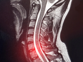 Exploring Sacro Occipital Technique Pelvic Block Treatment for Herniated Discs: A Case Study Review