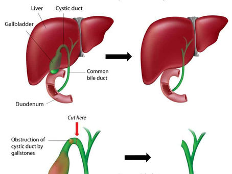 Exploring Visceral Mimicry Syndrome: A Chiropractic Approach to Post-Cholecystectomy Pain Relief
