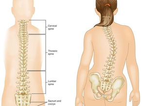 Understanding Adolescent Idiopathic Scoliosis Causes and Chiropractic Treatment Approaches