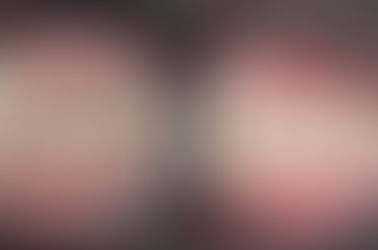 Pain Relief: How Chiropractic Treatment Addresses TMJ Issues Linked to Malocclusion