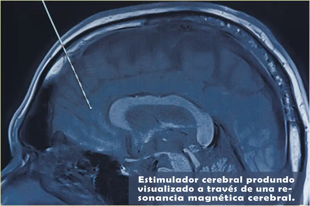 Estimulador cerebral profundo visualiado a través de una resonancia magnética cerebral.