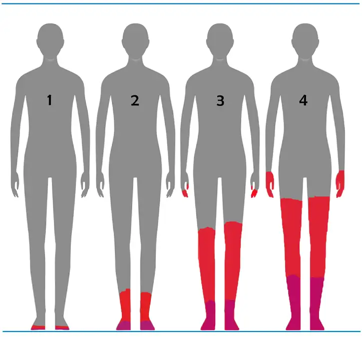 Evolución de la polineuropatía.