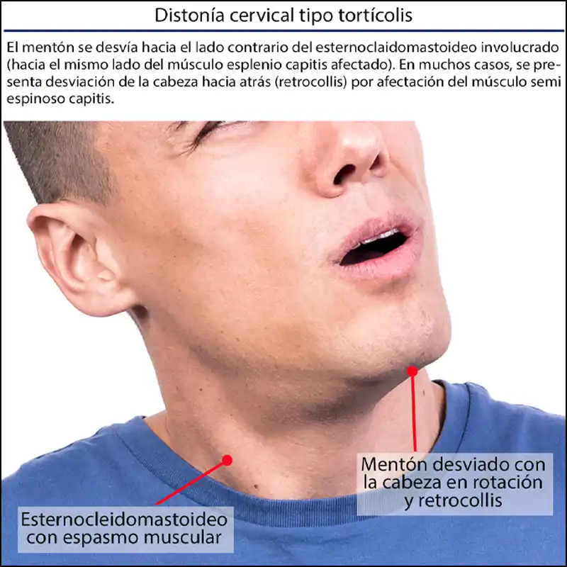 Distonía cervical tipo tortícolis.