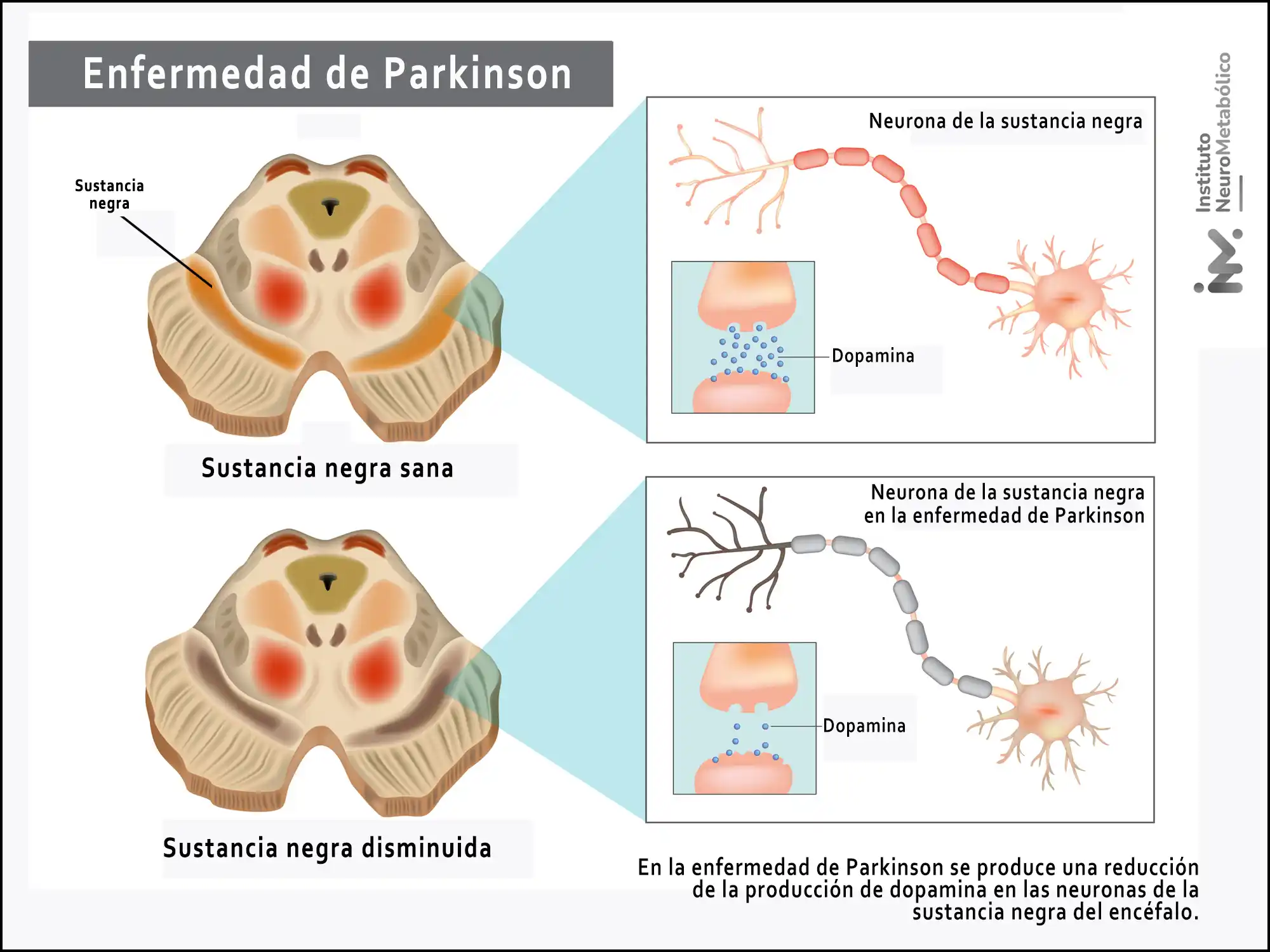 Enfermedad de Parkinson - Fisiopatología WP.webp