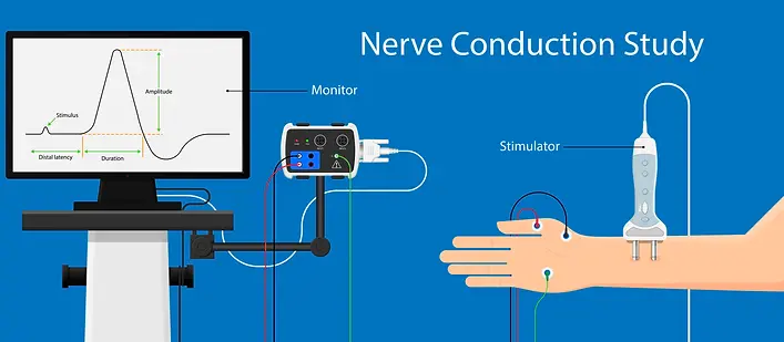 Estudio de conducción nerviosa.