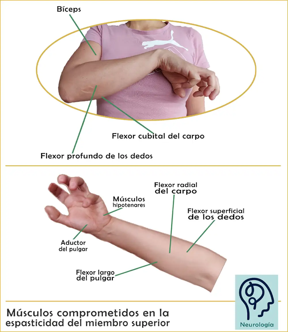 Músculos comprometidos en la espasticidad del miembro superior.