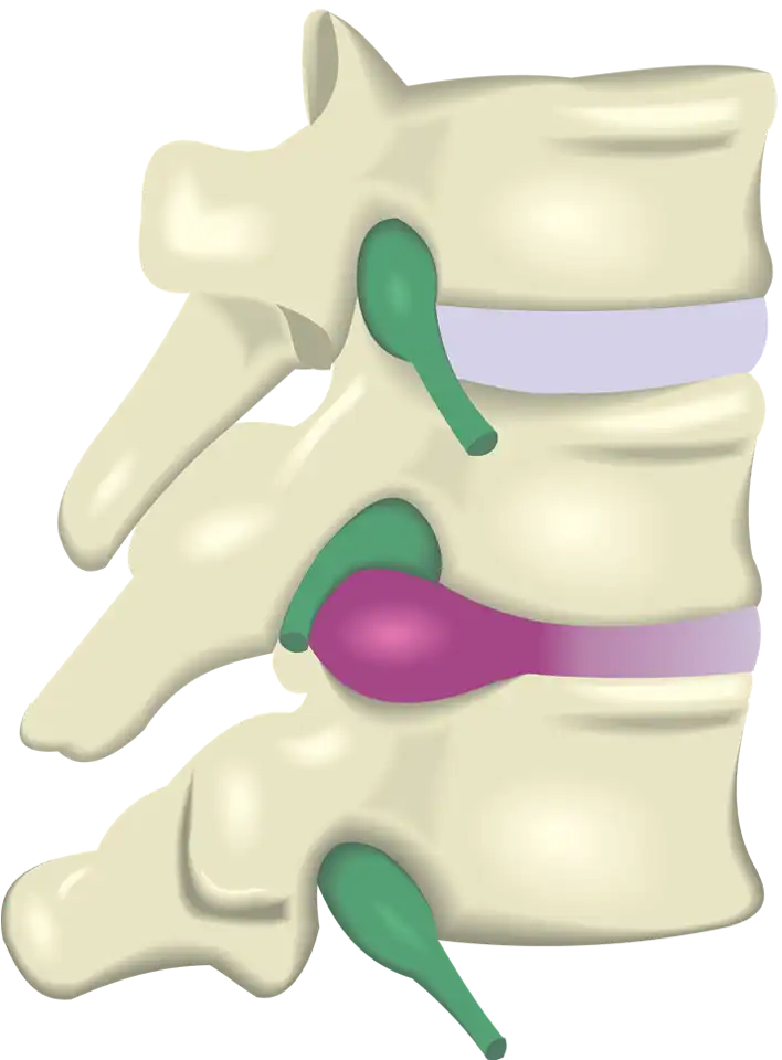 Hernia de la columna vertebral.