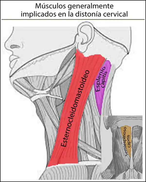 Músculos implicados en la distonía cervical.
