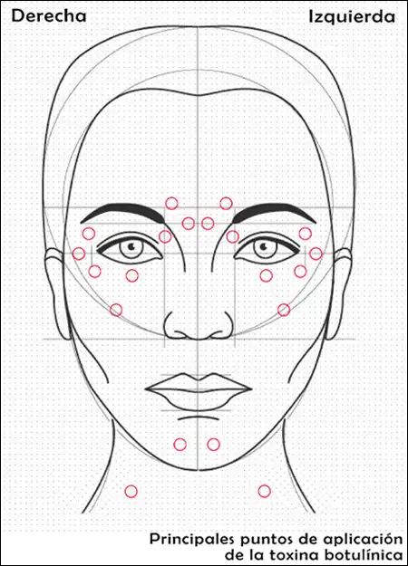Puntos de aplicación de toxina botulínica para espasmo facial WP.webp