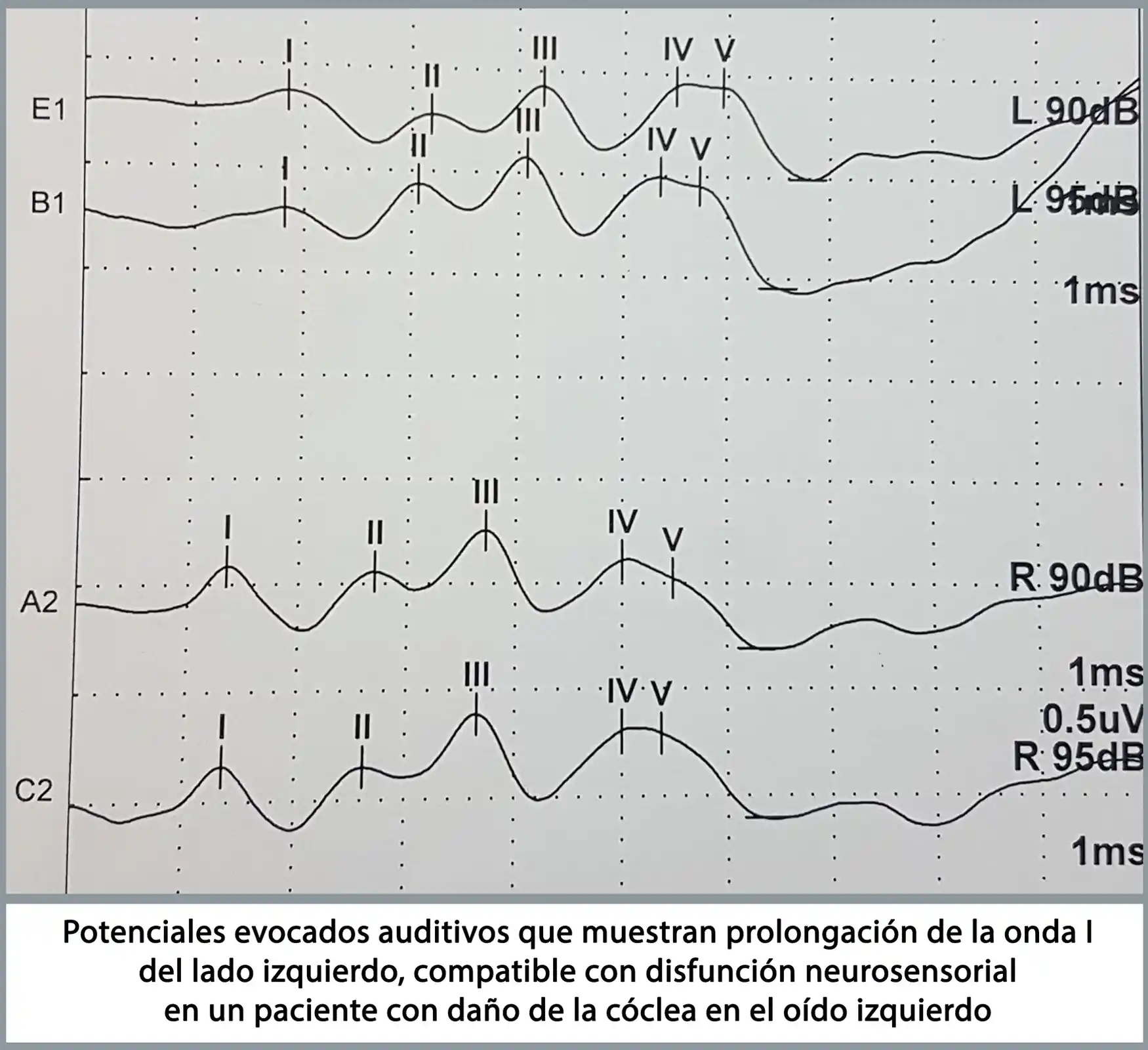 Ondas de los potenciales evocados auditivos.