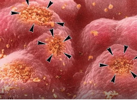 Pourquoi ne pas faire de régime Paléo ou Cétogène avec une perméabilité intestinale ?