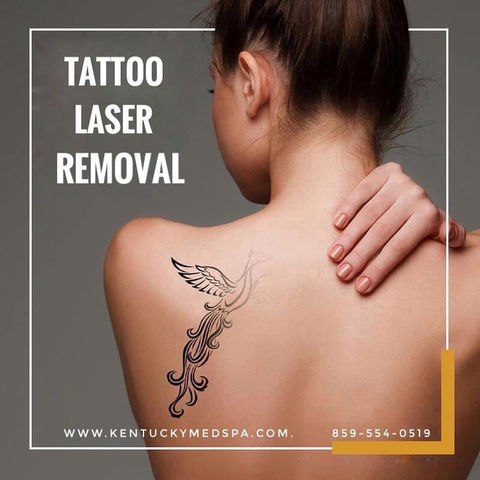 Laser Tattoo Removal Lexington KY