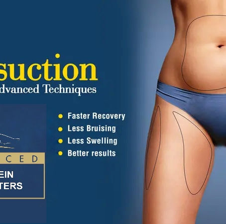 Power Assisted Liposuction: Enhancing Your Beauty at Advanced Skin and Vein Care Centers in Lexington, Kentucky
