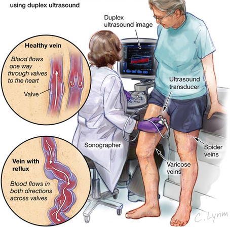 Varicose Veins Treatments in Lexington Kentucky