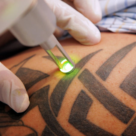 Best Tattoo Removal in Lexington & Georgetown KY!