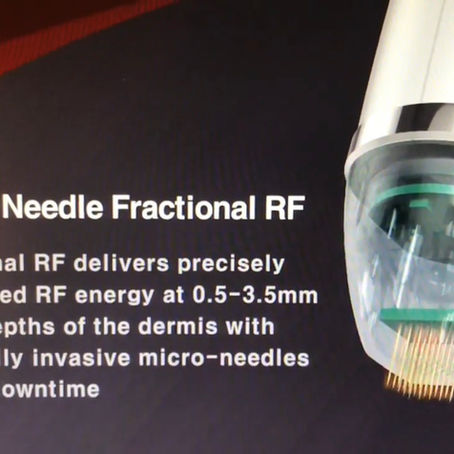 Benefits of Radiofrequency Microneedling