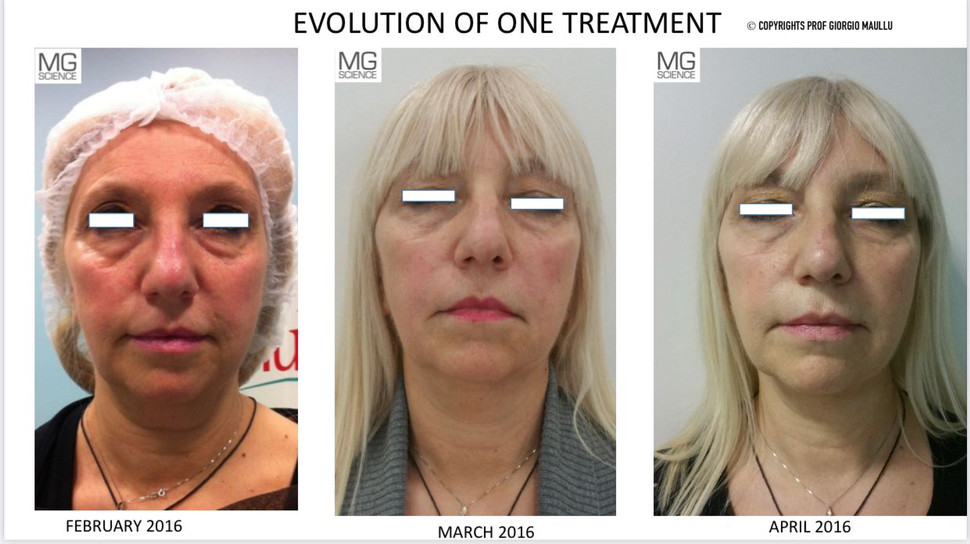 Attiva RF-Attiva USA-Facelift-Liposuction | ASVCC