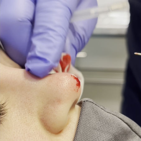 Nose Job with PDO threads, Lexington Kentucky