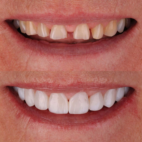 facetas de resina lentes de contato em resina dra katia blume novo hamburgo grande porto alegre 