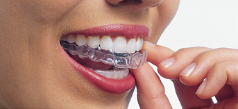 Invisalign-Offer-Huson-Dental-Center-Wes
