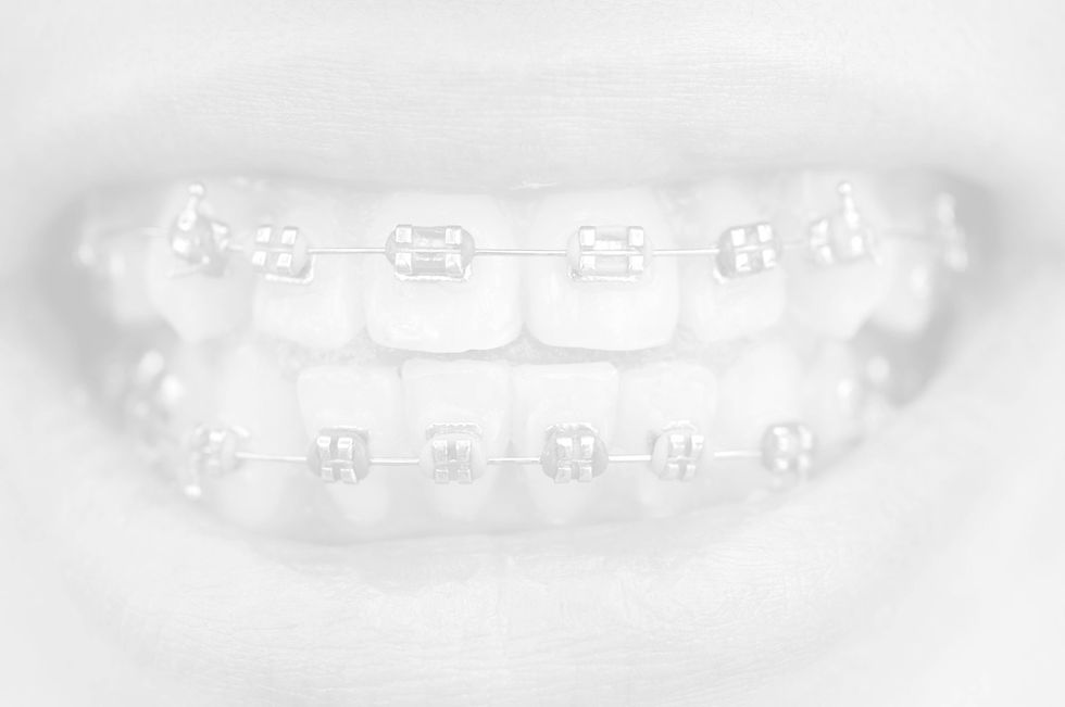 Braces on teeth
