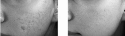 MICRO NEEDLING