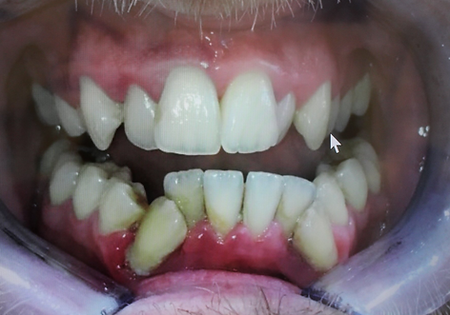 Ceramic braces before