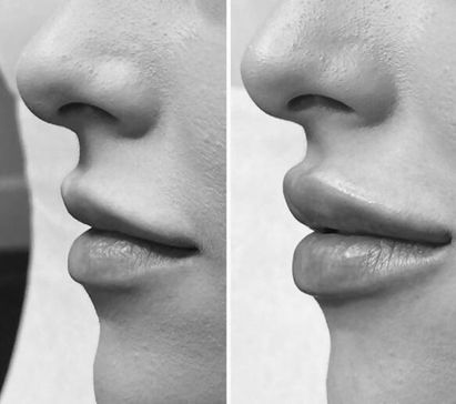 LIP FILLER