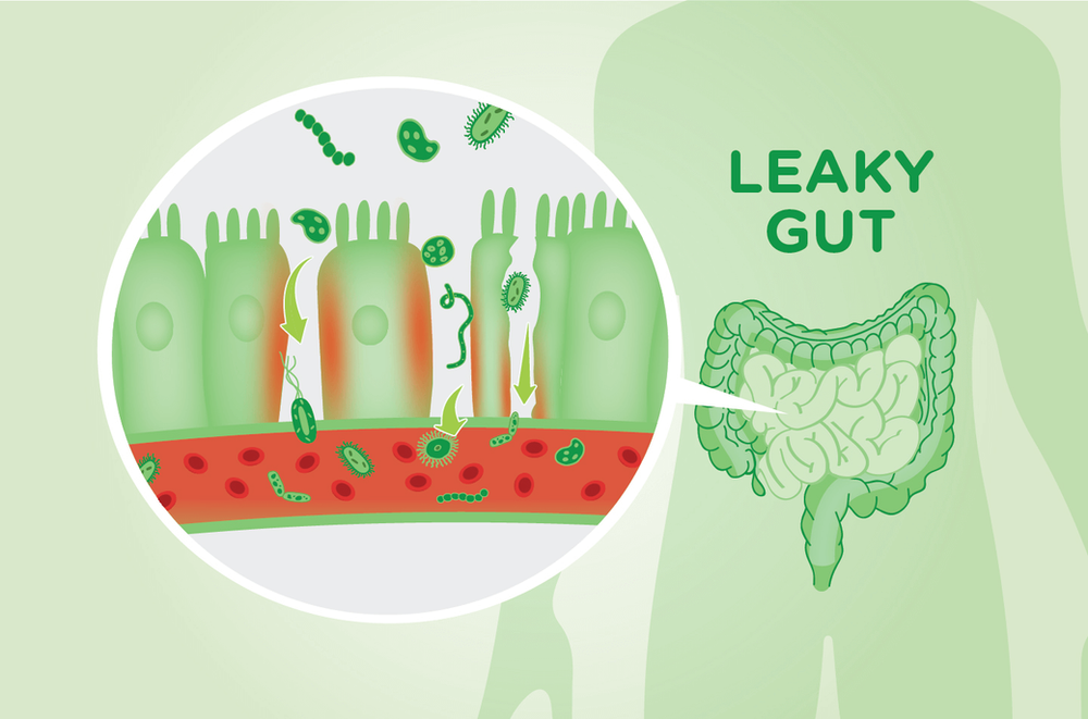 Leaky Gut, Gluten Intolerance and Celiac Disease