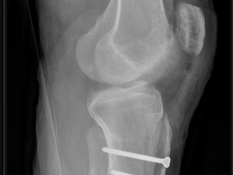 Tibial Tubercule Osteotomy