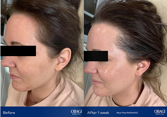 woman smiling before and after of chemical peels