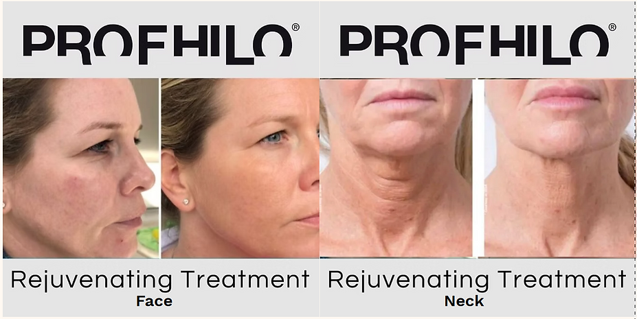 profhilo before and after.png