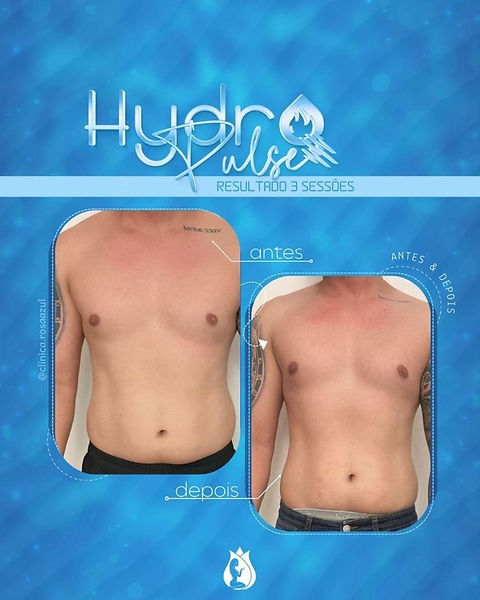 antes-e-depois-hydropulse-reducao-de-gordura-abdominal-sao-miguel-paulista