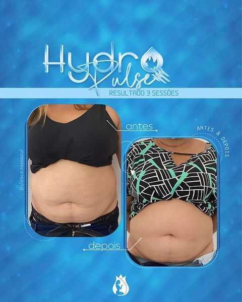 antes-e-depois-hydropulse-eliminar-gordura-abdominal-sao-paulo