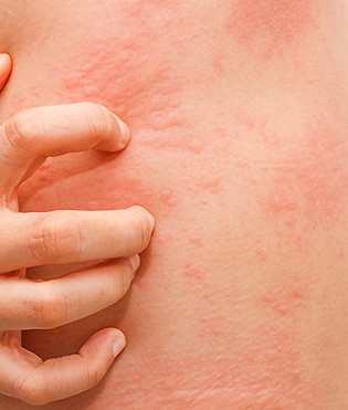 triadermatologia_dermatite-de-contato.jpeg