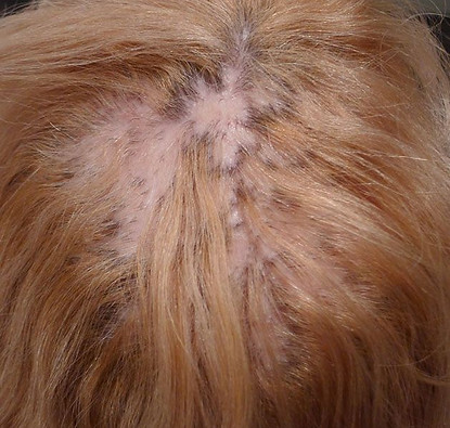 alopecia.jpg