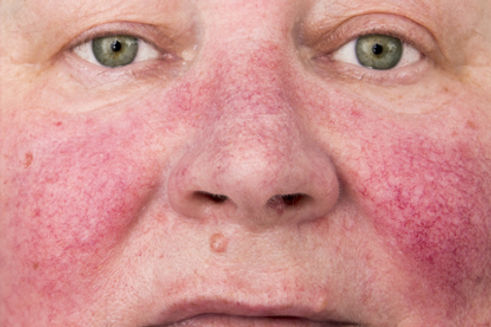 Injeção de Botox labial