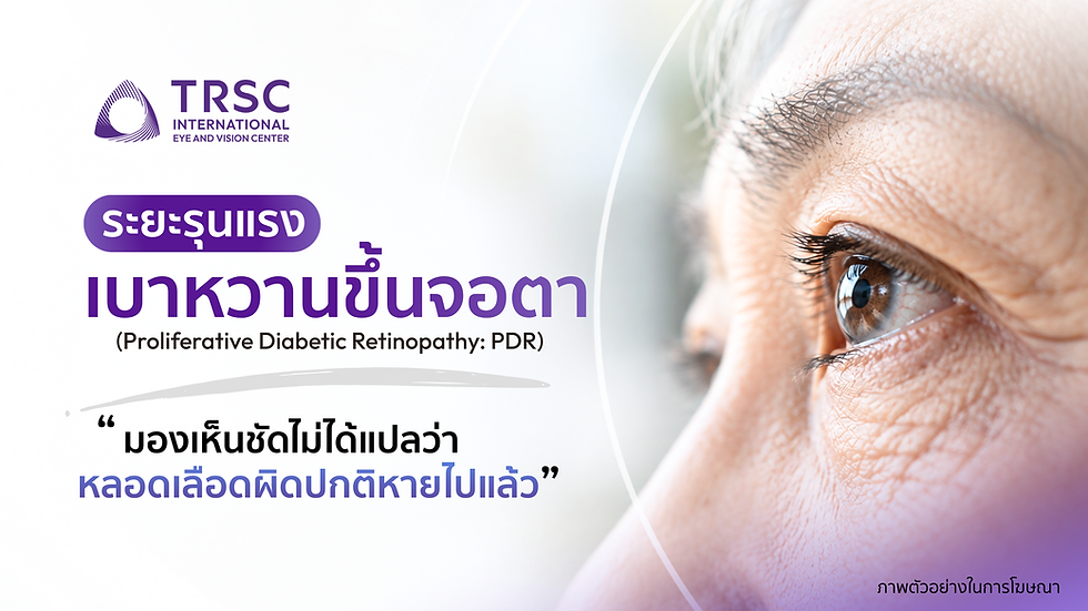 เบาหวานขึ้นจอตาระยะรุนแรง (Proliferative Diabetic Retinopathy: PDR)
