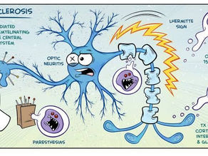 هجمة التصلب المتعدد