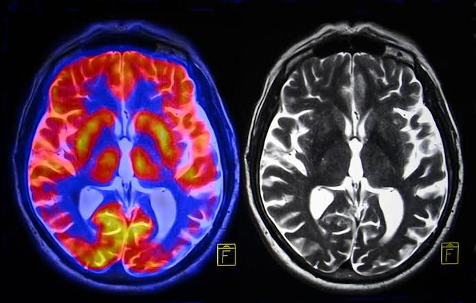 ما هي ظاهرة تناقض الاشعات مع الفحص والاعراض Clinico Radiological paradox
من الظواهر الملحوظة مع مرضى التصلب المتعدد
هو وجود تناقض في بعض المرضى ما بين حجم البؤر و الاعراض التي يعانون
 منها
بعض المرضى تحتوي الاشعات الخاصة بهم على بؤر كبيرة فالحجم بينما ظاهريا لا توجد اعراض او لو. وجدت لا تتناسب مع حجم البؤر 
والبعض الاخر تحتوي الاشعات الهاصة بهم على بؤر صغيرة فالحجم ولكن دائما ما يشتكوا من اعراض جديدة او تدهورةفي الحالة 
وجدت الدراسات ظاهرة الclinioco radiological paradox 
والتي تعزى لاكثر من سبب منها 
-اماكن البؤر 
فبعض البؤر في أماكن مثل جذع المخ او المخيخ او النهاع الشوكي اكثر تاثير في الاعراض من بؤر المخ 
-التكيف Adaptive plasticity 
عوامل جينية تؤدي الى تكيف الجسم والسيولة العصبية مع الضرر الحادث عن تضرر غشاء المايلين وتختلف من مريض لاخر 
-الرنين التقليدي يوضح فقط اماكن البؤر 
بينما يمكن مع استخدام الرنين تلوظيفي اظهار ابعاد اخرى للمرض مثل ضمور مراكز المخ وتاثيرها على الاعراض 
لذلك يجب دائما الحرص ومتابعه الاعراض حتى ان لم تتماثل مع البؤر الموجودة في الاشعات


