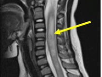 مرض التهاب النخاع الشوكي المستعرض تشخيصه وعلاجه Transverse Myelitis