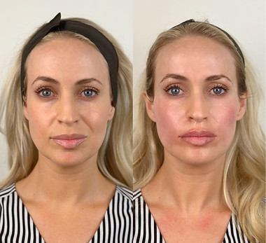 6564dfa3bf6aec3d1814f3f0_64e526c242aa063fa00db27e_beforeandaftercheekfiller-Large-1024x102
