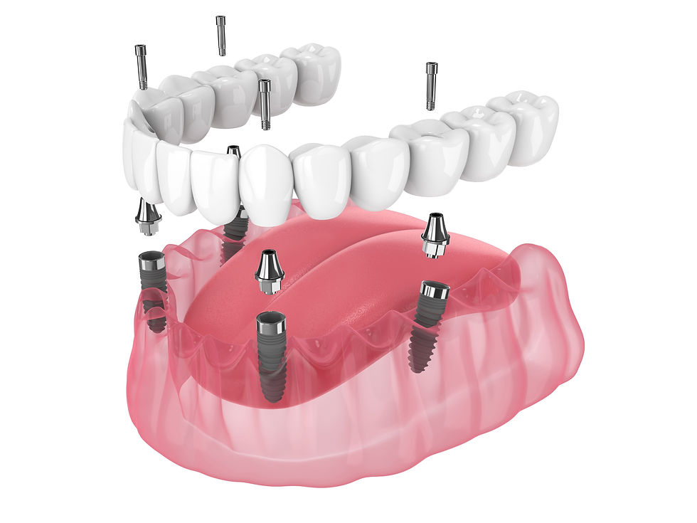 Replace All Teeth