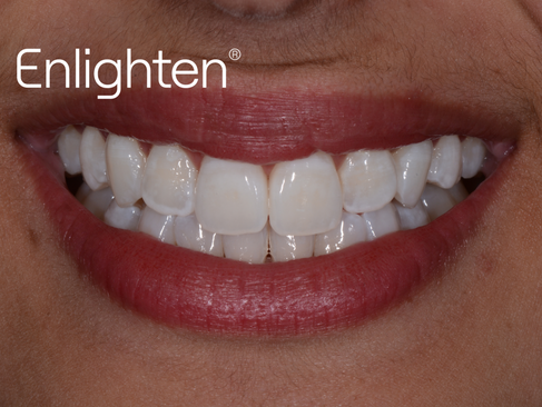 Teeth Whitening in Bow, East London