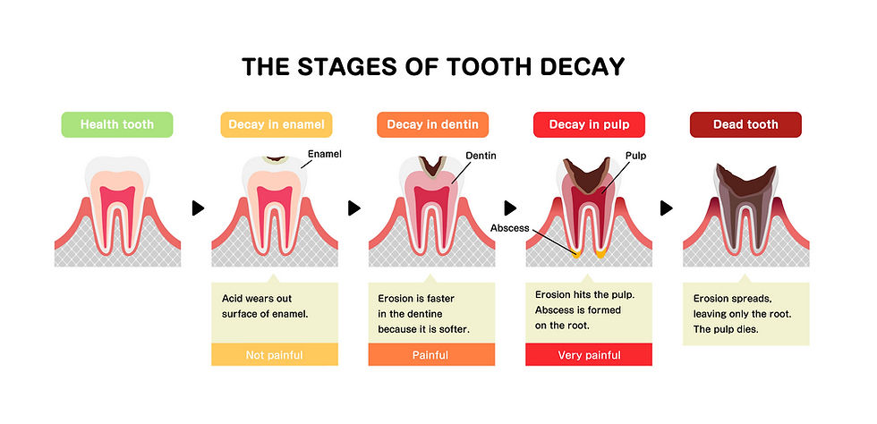 William Place Dental Aesthetics, East London Dentist, Bow Dentist, Tooth Decay